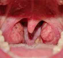 Nosní mandle - není jednoduchá nemoc