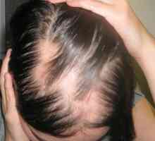 Alopecie - nemoc, která za? Příčiny, Příznaky, Léčba plešatosti