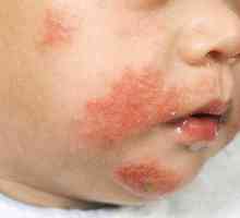 Atopická dermatitida v léčbě a symptomy dítěte