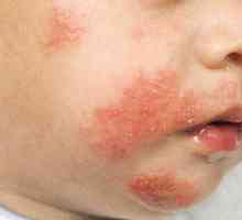 Atopická dermatitida je dítě: příčiny, příznaky, léčba
