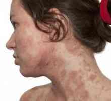 Atopie - atopická dermatitida je ...