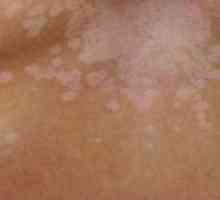 Bílé skvrny na kůži po spálení: léčba, picture