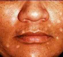Bílé skvrny na obličeji může být příznakem vitiligo