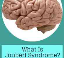 Onemocnění na úrovni genetiky - Joubert syndrom