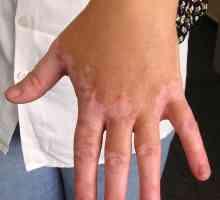 Vitiligo nemoc: příčiny, příznaky a léčebné metody