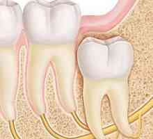 Bolavý zub moudrosti: jak k úlevě od bolesti? Jak zmírnit bolest vybuchnutí zuby moudrosti?