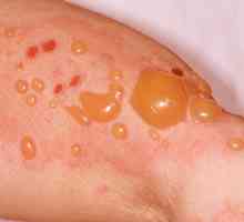 Bulózní dermatitida: příčiny, příznaky, diagnostika a léčba