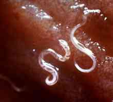 Worms u člověka. Škrkavky jsou paraziti Léčba a prevence