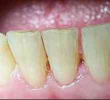 Co kdyby tam byly trhliny v zubech? Příčiny a léčba