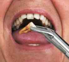 Co dělat po extrakci zubu - jak zastavit krvácení a hojení ran