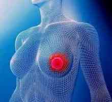 Co je prsu, příčiny, příznaky a léčba