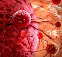 Co je rakovina metastazující? Maligní nádory a metastázy