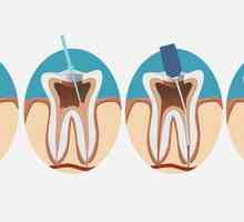 Zubní kořenový kanálek: k dispozici procedury, indikace