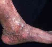 Dermatitis na nohou