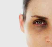Máte-li tmavé oční víčka, co to znamená a jak s ní bojovat?