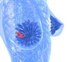Fibrocystické onemocnění prsů: léčba, příznaky a příčiny
