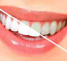 Fluoridace zubů - co to je? Jak je postup hlubokého fluoridace zubů?