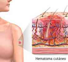 Hematom - hematom ...: typy, příčiny, příznaky