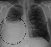 Hydrothorax jednoduché: příčiny, příznaky a léčba