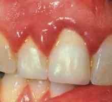 Zánět dásní: kloktadlo při zánětech dásní?