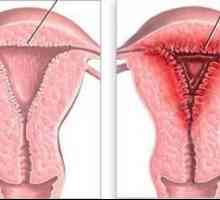Hyperplazie endometria: co je to? Příčiny, příznaky a léčebné metody
