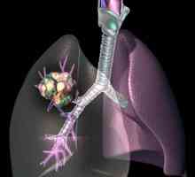 Chemoterapie pro rakovinu plic. Jak k léčbě rakoviny plic