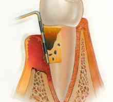 Chronické a akutní parodontitidy: symptomy, příčiny a léčba