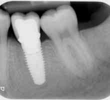 Zubní implantáty: kontraindikace a možné komplikace (recenze)