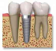Zubní implantáty: Pacient hodnocení chirurgie