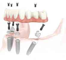 Zubní implantáty: kontraindikace, skutečné škody