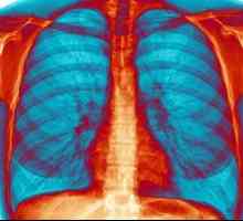 Inhalace bronchitida: nejen možné, ale nutné!