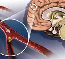 Zdvih: symptomy a následky. Hlavními příznaky cévní mozkové příhody a microstroke