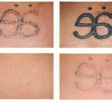 Zbavit se chyb z minulosti: Laserové odstranění tetování