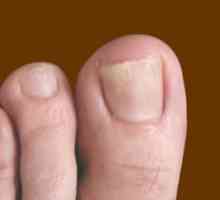 Účinná léčba plísňové nehty lidových prostředků