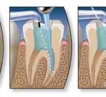 Endodontické terapie zubů. etapy endodontic