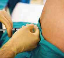 Epidurální anestézie pro císařský řez: indikace a výhody