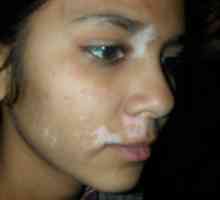 Jak se k léčbě vitiligo, zvýšit šanci na zotavení