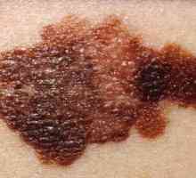 Jak se pozná melanom v raném stádiu? Známky a příznaky melanomu kůže (foto)