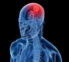Jaký je příznakem rakoviny mozku je první budíček?