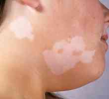 Jaké jsou příznaky a příčiny vitiligo?