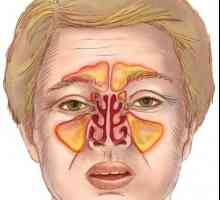 Jaké jsou příznaky zánětu vedlejších nosních dutin? léčba onemocnění
