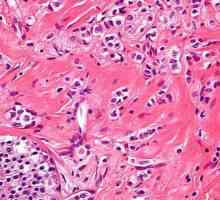 Karcinom - Co je to? karcinom dlaždicových buněk