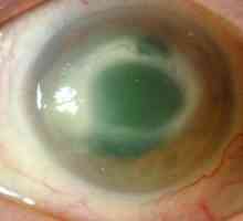 Rohovky oka: Známky, příčiny a léčba