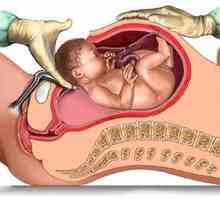 Císařský řez: zotavení po porodu a následnou prognózou