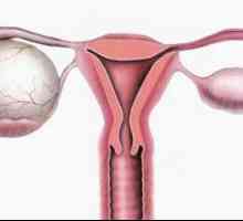 Levý ovariální cysta, jeho typy a léčba