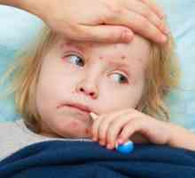 Spalničky je dítě: příznaky a léčba