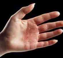 Sinister dermatitidy na rukách: léčba