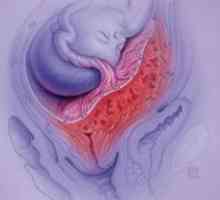 Marginální placenta previa - hrozba pro normální průběh těhotenství