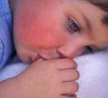 Červená skvrna na tvář dítěte: příčiny, příznaky a léčebné vlastnosti