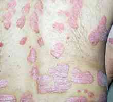 Červené šupinaté plochy na těle: pásový opar a další plísňové infekce